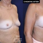 Patient 20076's breast implant before and after results at Contemporary Plastic Surgery