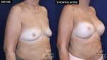 Patient 20076's breast implant before and after results at Contemporary Plastic Surgery