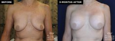 patient 20153 breast augmentation results at Contemporary Plastic Surgery