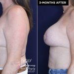 patient #20230 breast lift with implants before and after results at Contemporary Plastic Surgery