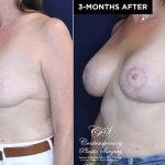 patient #20230 breast lift with implants before and after results at Contemporary Plastic Surgery