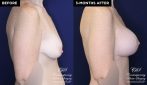 Patient #20360 breast augmentation before and after results at Contemporary Plastic Surgery