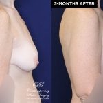 Patient #20360 breast augmentation before and after results at Contemporary Plastic Surgery