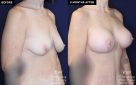 Patient #20360 breast augmentation before and after results at Contemporary Plastic Surgery