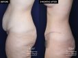 Patient #20360 tummy tuck before and after results at Contemporary Plastic Surgery