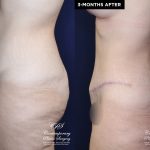 Patient #20360 tummy tuck before and after results at Contemporary Plastic Surgery