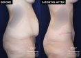 Patient #20360 tummy tuck before and after results at Contemporary Plastic Surgery