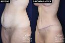 Patient #20360 tummy tuck before and after results at Contemporary Plastic Surgery