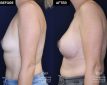 patient 20477 breast augmentation results at Contemporary Plastic Surgery