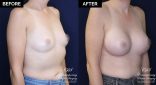 patient 20477 breast augmentation results at Contemporary Plastic Surgery