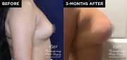 patient 20700 breast augmentation results at Contemporary Plastic Surgery
