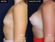 patient #20920 breast augmentation results at Contemporary Plastic Surgery