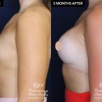 patient #20920 breast augmentation results at Contemporary Plastic Surgery