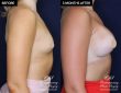 patient #20920 breast augmentation results at Contemporary Plastic Surgery