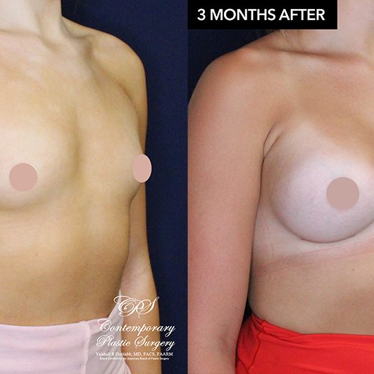 patient #20920 breast augmentation results at Contemporary Plastic Surgery