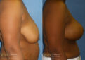 breast lift before and after