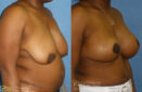 breast lift before and after