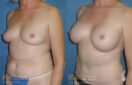 breast augmentation