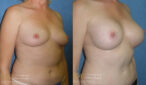 breast augmentation