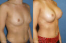 breast augmentation
