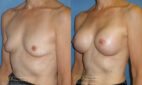 breast augmentation