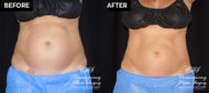 Patient's before and after results from CoolSculpting treatment at Contemporary Plastic Surgery