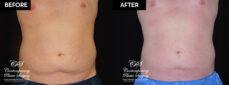 Patient's before and after results from CoolSculpting treatment at Contemporary Plastic Surgery