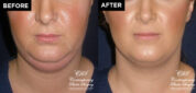 patient results before & after Kybella injections at Contemporary Plastic Surgery
