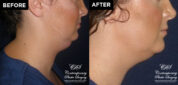 patient results before & after Kybella injections at Contemporary Plastic Surgery