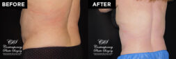 Patient's before and after results from CoolSculpting treatment at Contemporary Plastic Surgery