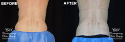 Patient's before and after results from CoolSculpting treatment at Contemporary Plastic Surgery