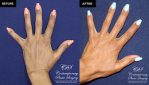 patient before and after results of Radiesse injectable treatment in the back of hands at Contemporary Plastic Surgery