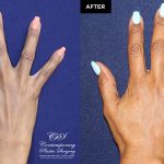 patient before and after results of Radiesse injectable treatment in the back of hands at Contemporary Plastic Surgery