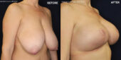 breast augmentation
