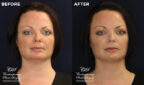 patient results before & after Kybella injections at Contemporary Plastic Surgery