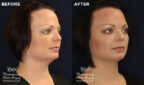patient results before & after Kybella injections at Contemporary Plastic Surgery