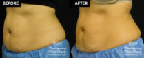 Patient's before and after results from CoolSculpting treatment at Contemporary Plastic Surgery
