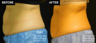 Patient's before and after results from CoolSculpting treatment at Contemporary Plastic Surgery