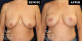 breast lift before and after