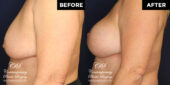 breast lift before and after