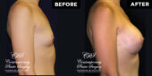 breast augmenatation 11430