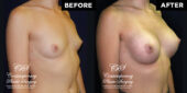 breast augmentation 11430