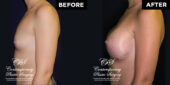breast augmentation 11430