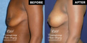 breast augmentation 4161