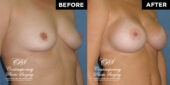 breast augmentation
