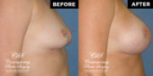 breast augmentation