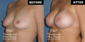 breast augmentation