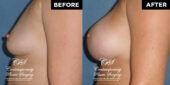 breast augmentation