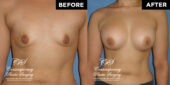 breast augmentation