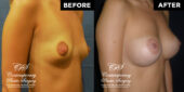 breast augmentation